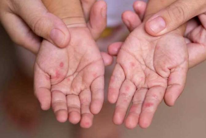 At Least 50 Confirmed Cases of Measles in Armenia